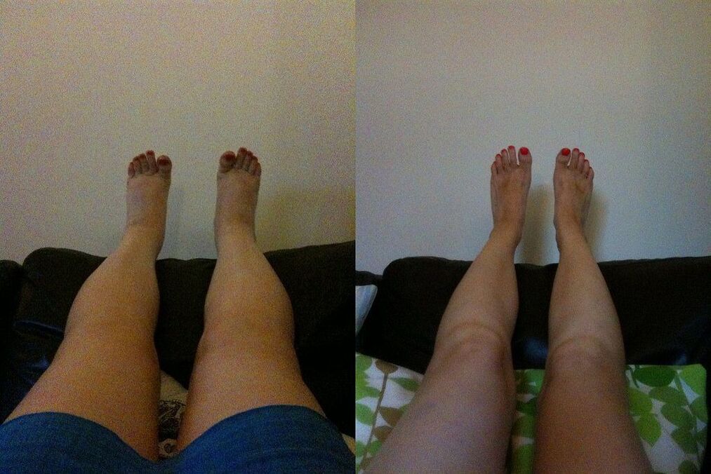Effective results before and after using Margarita's Ostelife Premium Plus cream