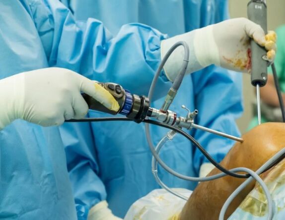 Arthroscopy