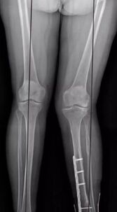 Knee deformation