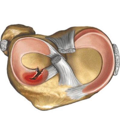 Meniscus damage