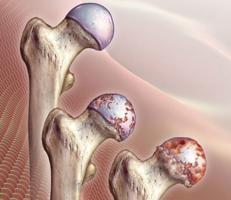 Hip arthritis
