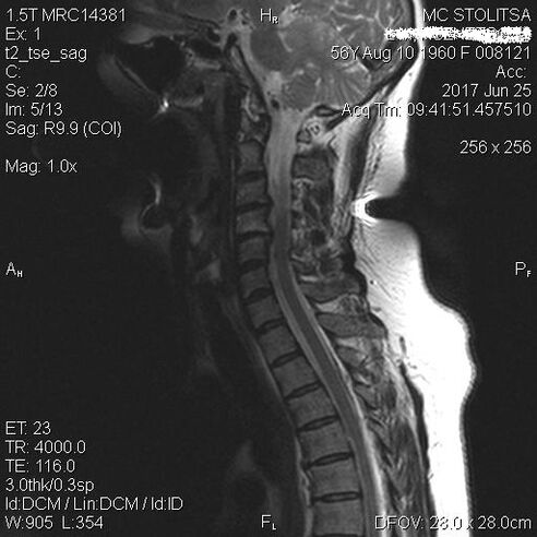 Osteochondrosis and spinal disease in the cervical vertebrae