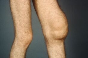 Causes and symptoms of knee joint joints