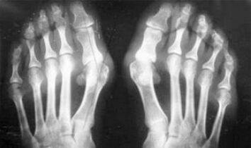 Differential diagnosis of symptoms of arthritis and arthritis