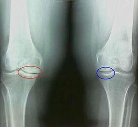 Results of folk therapies for treating arthritis and arthritis