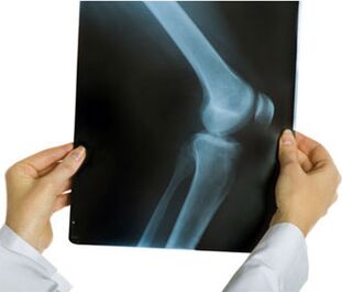 X-rays for knee arthritis