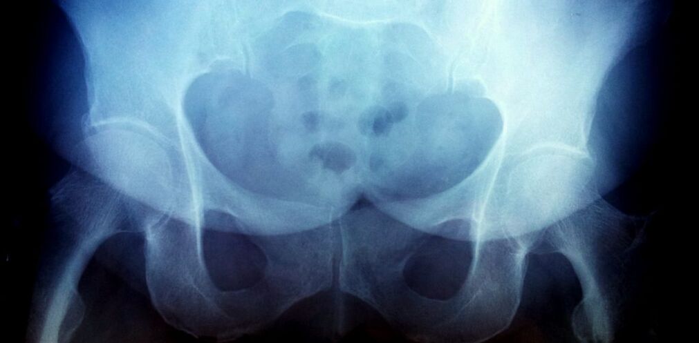 X-ray diagram and second degree joint